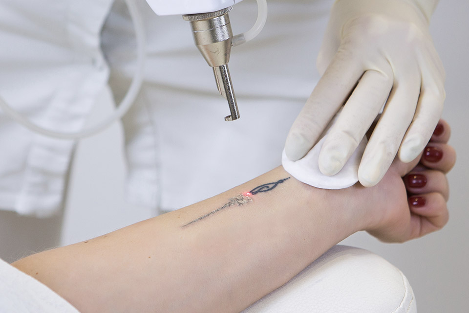 TATTOO-REMOVAL-Q-SWITCH-ND-YAG-LASER